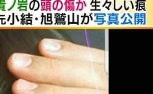 【閲覧注意】貴ノ岩の傷の写真が公開される【画像あり】