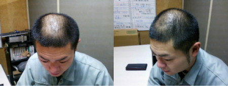 【悲報】人気お笑い芸人のあばれるくん（26）ガチでハゲてしまう…！ （※画像あり）